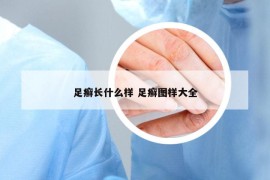 足癬長什么樣 足癬圖樣大全