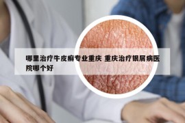 哪里治療牛皮癬專業(yè)重慶 重慶治療銀屑病醫(yī)院哪個(gè)好