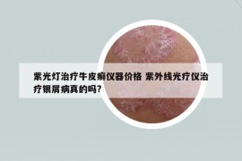 紫光燈治療牛皮癬儀器價(jià)格 紫外線光療儀治療銀屑病真的嗎?