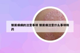 銀屑病病的注意事項(xiàng) 銀屑病注意什么事項(xiàng)和藥