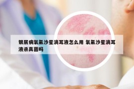 銀屑病氧氟沙星滴耳液怎么用 氧氟沙星滴耳液殺真菌嗎