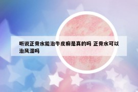 聽說正骨水能治牛皮癬是真的嗎 正骨水可以治風(fēng)濕嗎