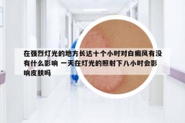 在強(qiáng)烈燈光的地方長(zhǎng)達(dá)十個(gè)小時(shí)對(duì)白癜風(fēng)有沒(méi)有什么影響 一天在燈光的照射下八小時(shí)會(huì)影響皮膚嗎