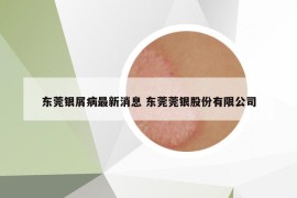東莞銀屑病最新消息 東莞莞銀股份有限公司