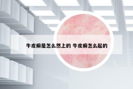 牛皮癬是怎么然上的 牛皮癬怎么起的