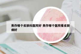 焦作哪個(gè)皮膚科醫(yī)院好 焦作哪個(gè)醫(yī)院看皮膚病好