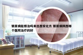 銀屑病能根治嗎來選西安北方 銀屑病陜西哪個醫(yī)院治療的好
