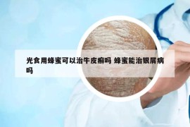 光食用蜂蜜可以治牛皮癬嗎 蜂蜜能治銀屑病嗎