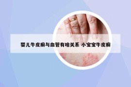嬰兒牛皮癬與血管有啥關(guān)系 小寶寶牛皮癬
