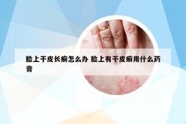 臉上干皮長癬怎么辦 臉上有干皮癬用什么藥膏