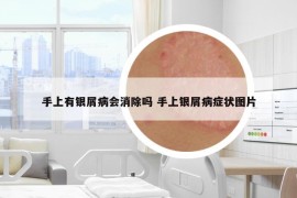 手上有銀屑病會(huì)消除嗎 手上銀屑病癥狀圖片