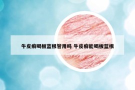 牛皮癬喝板藍(lán)根管用嗎 牛皮癬能喝板藍(lán)根