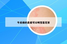 牛皮癬的患者可以喝雪蓮花茶