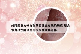 維阿露復(fù)方卡力孜然酊涂完皮膚灼燒感 復(fù)方卡力孜然酊涂后周圍皮膚變黑怎樣