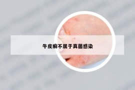 牛皮癬不屬于真菌感染