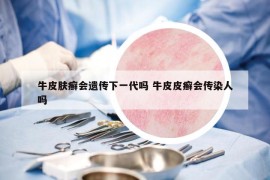 牛皮膚癬會遺傳下一代嗎 牛皮皮癬會傳染人嗎