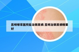 昆明哪家醫(yī)院能治銀屑病 昆明治銀屑病哪里好