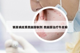 銀屑病皮質(zhì)類固醇制劑 類固醇治療牛皮癬
