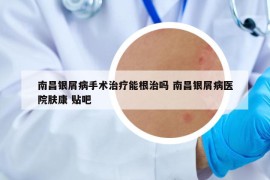 南昌銀屑病手術(shù)治療能根治嗎 南昌銀屑病醫(yī)院膚康 貼吧