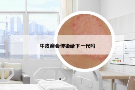 牛皮癬會(huì)傳染給下一代嗎
