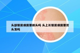 頭部銀屑病需要剃頭嗎 頭上長銀屑病需要剪頭發(fā)嗎