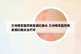 蘭州哪家醫(yī)院銀屑病紅糖水 蘭州哪家醫(yī)院銀屑病紅糖水治療好
