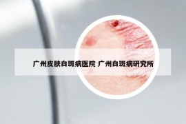 廣州皮膚白斑病醫(yī)院 廣州白斑病研究所