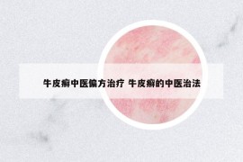 牛皮癬中醫(yī)偏方治療 牛皮癬的中醫(yī)治法