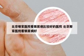 北京哪家醫(yī)院看銀屑病比較好的醫(yī)院 北京那家醫(yī)院看銀屑病好