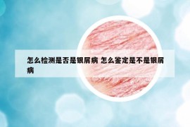 怎么檢測是否是銀屑病 怎么鑒定是不是銀屑病