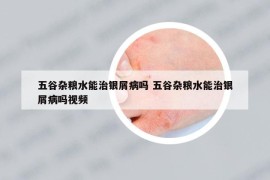 五谷雜糧水能治銀屑病嗎 五谷雜糧水能治銀屑病嗎視頻