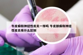 牛皮癬和神經(jīng)性皮炎一樣嗎 牛皮膚癬和神經(jīng)性皮炎有什么區(qū)別