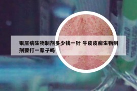 銀屑病生物制劑多少錢一針 牛皮皮癬生物制劑要打一輩子嗎