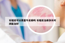 石榴皮可以質(zhì)量牛皮癬嗎 石榴皮治癬多長時(shí)間能治好