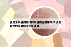 合肥治銀屑病最好的銀屑病醫(yī)院哪家好 合肥最好的銀屑病醫(yī)院是哪里