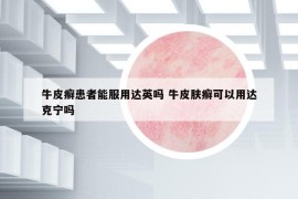 牛皮癬患者能服用達(dá)英嗎 牛皮膚癬可以用達(dá)克寧嗎