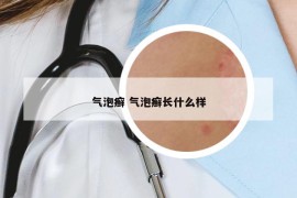 氣泡癬 氣泡癬長什么樣