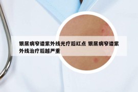 銀屑病窄譜紫外線光療后紅點 銀屑病窄譜紫外線治療后越嚴(yán)重