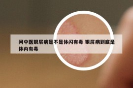 問(wèn)中醫(yī)銀屑病是不是體閃有毒 銀屑病到底是體內(nèi)有毒