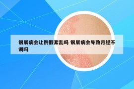 銀屑病會讓例假紊亂嗎 銀屑病會導致月經(jīng)不調(diào)嗎