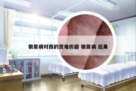 銀屑病對我的苦難折磨 銀屑病 后果