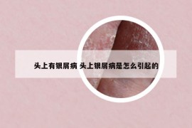 頭上有銀屑病 頭上銀屑病是怎么引起的