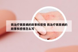 我治療銀屑病的故事和感悟 我治療銀屑病的故事和感悟怎么寫