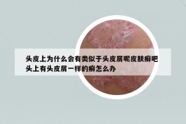 頭皮上為什么會有類似于頭皮屑呢皮膚癬吧 頭上有頭皮屑一樣的癬怎么辦