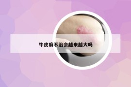 牛皮癬不治會(huì)越來(lái)越大嗎