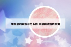銀屑病的婚姻會怎么樣 銀屑病結婚的案例