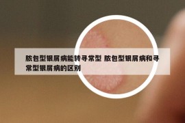 膿包型銀屑病能轉(zhuǎn)尋常型 膿包型銀屑病和尋常型銀屑病的區(qū)別