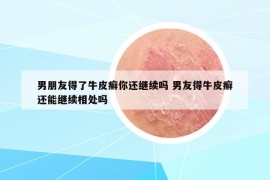 男朋友得了牛皮癬你還繼續(xù)嗎 男友得牛皮癬還能繼續(xù)相處嗎