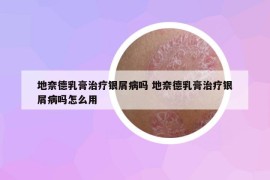 地奈德乳膏治療銀屑病嗎 地奈德乳膏治療銀屑病嗎怎么用