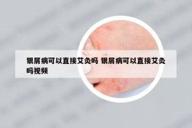 銀屑病可以直接艾灸嗎 銀屑病可以直接艾灸嗎視頻
